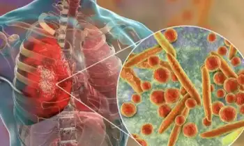 Infeksi Mycoplasma Pneumonia