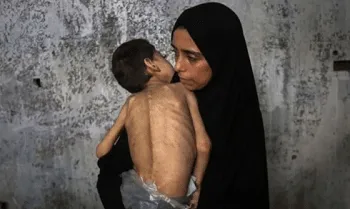Seorang anak Palestina yang menderita kurang gizi dan cerebral palsy digendong ibunya di tempat pengungsian di Gaza, Palestina