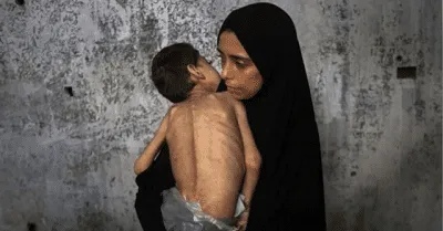 Seorang anak Palestina yang menderita kurang gizi dan cerebral palsy digendong ibunya di tempat pengungsian di Gaza, Palestina